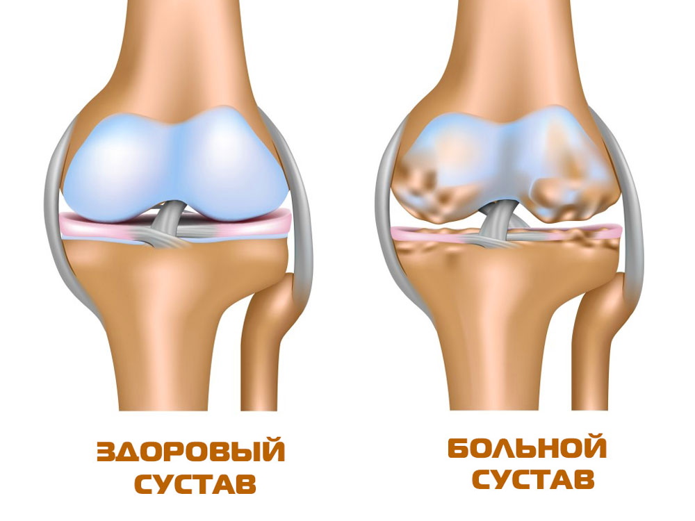 gonartroza koljena artroza care deformează genunchiul